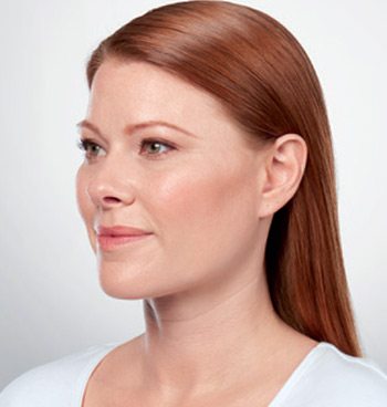 After Kybella® Neck Tightening Treatment