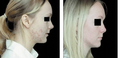 Omnilux blue acne treatment