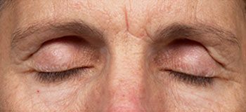 Before Thermage® Brow Lift