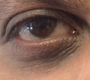 After Eye Therapy 236