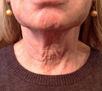 Before Neck Therapy 239