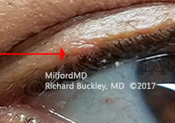 After Upper Eyelid Growth Removal