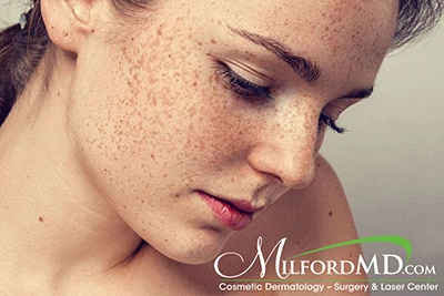 September 2018 Lasers for Freckles By MilfordMD