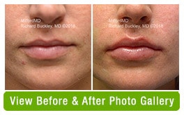 Before & After Lip Filler Treatments
