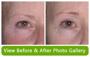 Before and After Photo Gallery of Non-Surgical Brow Lifts
