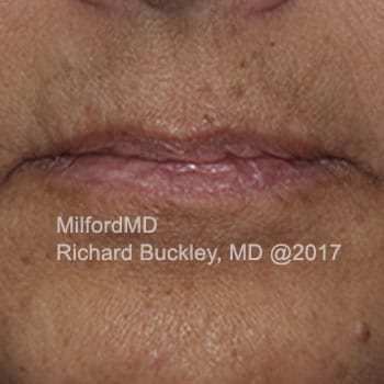 Before Photo of Lip Augmentation at MilfordMD