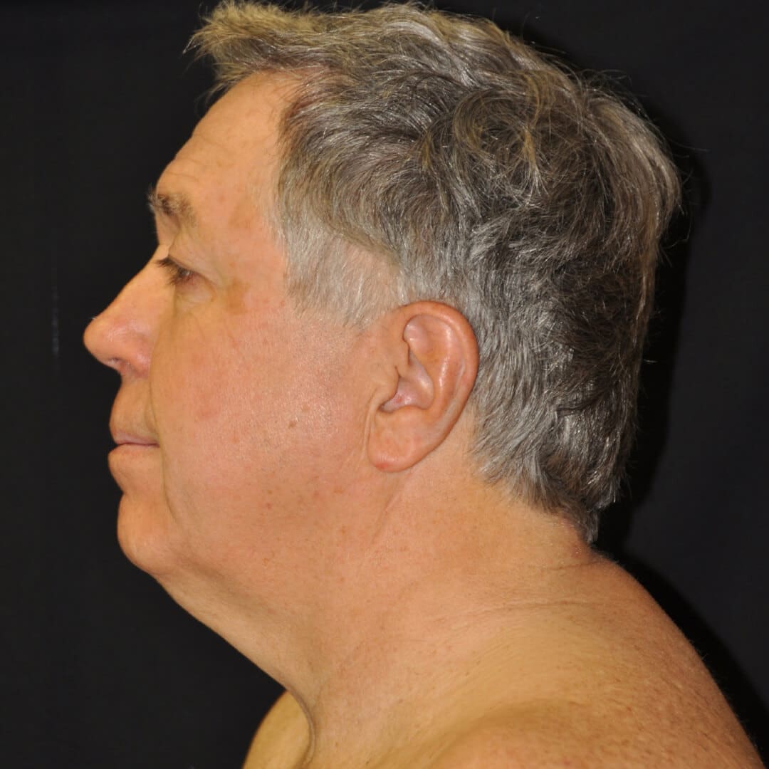 Before: NECK LASER Liposuction – CASE #16600