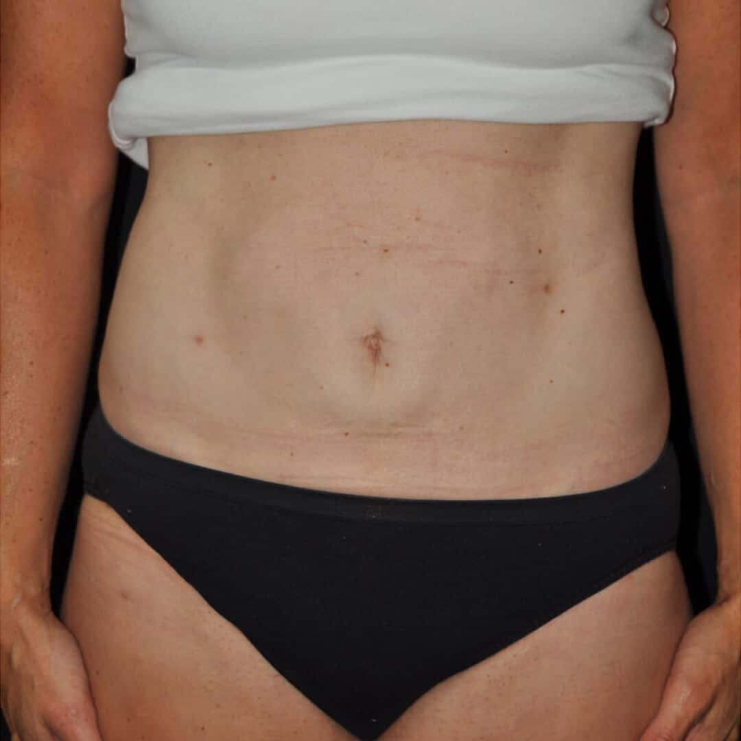 Laser Liposuction Before and After Photos,Laser Liposuction Before and After,Laser Liposuction Before & After,Before and After Laser Liposuction,Laser Liposuction Before & After Pictures, LASER LIPOSUCTION – CASE #35666