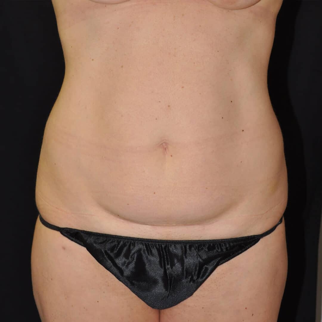 Laser Liposuction Before and After Photos,Laser Liposuction Before and After,Laser Liposuction Before & After,Before and After Laser Liposuction,Laser Liposuction Before & After Pictures, LASER LIPOSUCTION – CASE #35666
