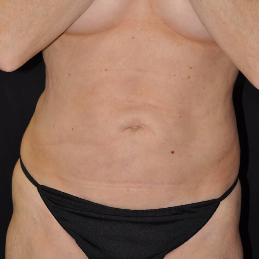 Laser Liposuction Before and After Photos,Laser Liposuction Before and After,Laser Liposuction Before & After,Before and After Laser Liposuction,Laser Liposuction Before and After Pictures, LASER LIPOSUCTION – CASE #35705