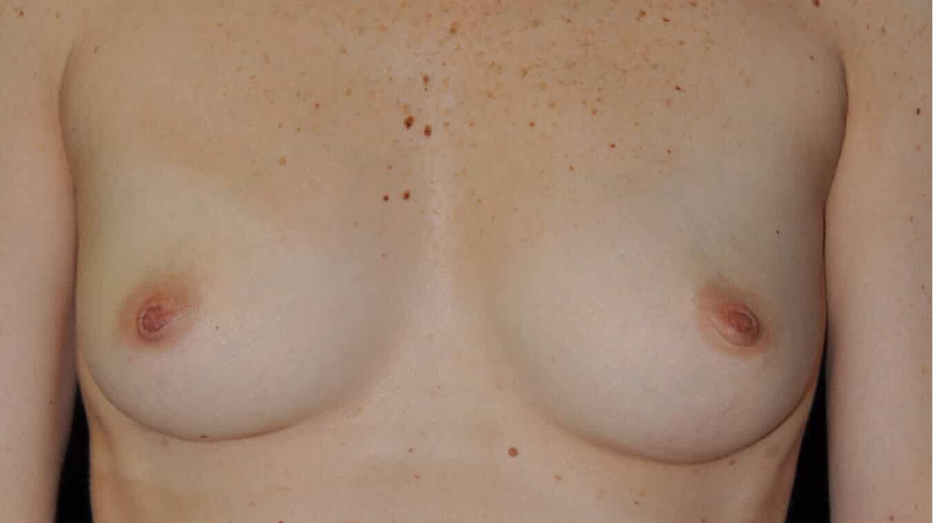 Before: BREAST AUGMENTATION AFT – CASE #35722