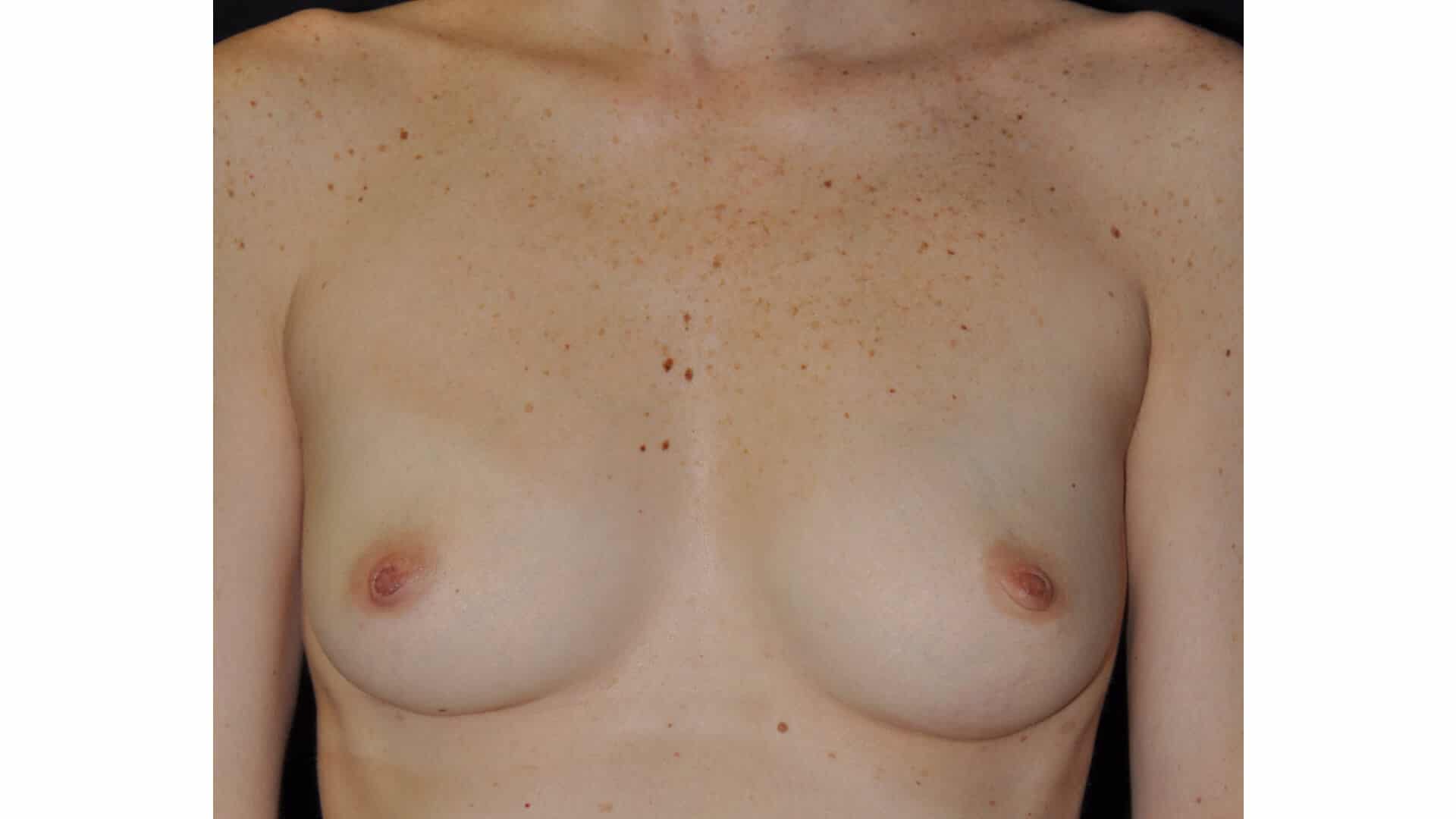 Before: BREAST AUGMENTATION AFT – CASE #35722