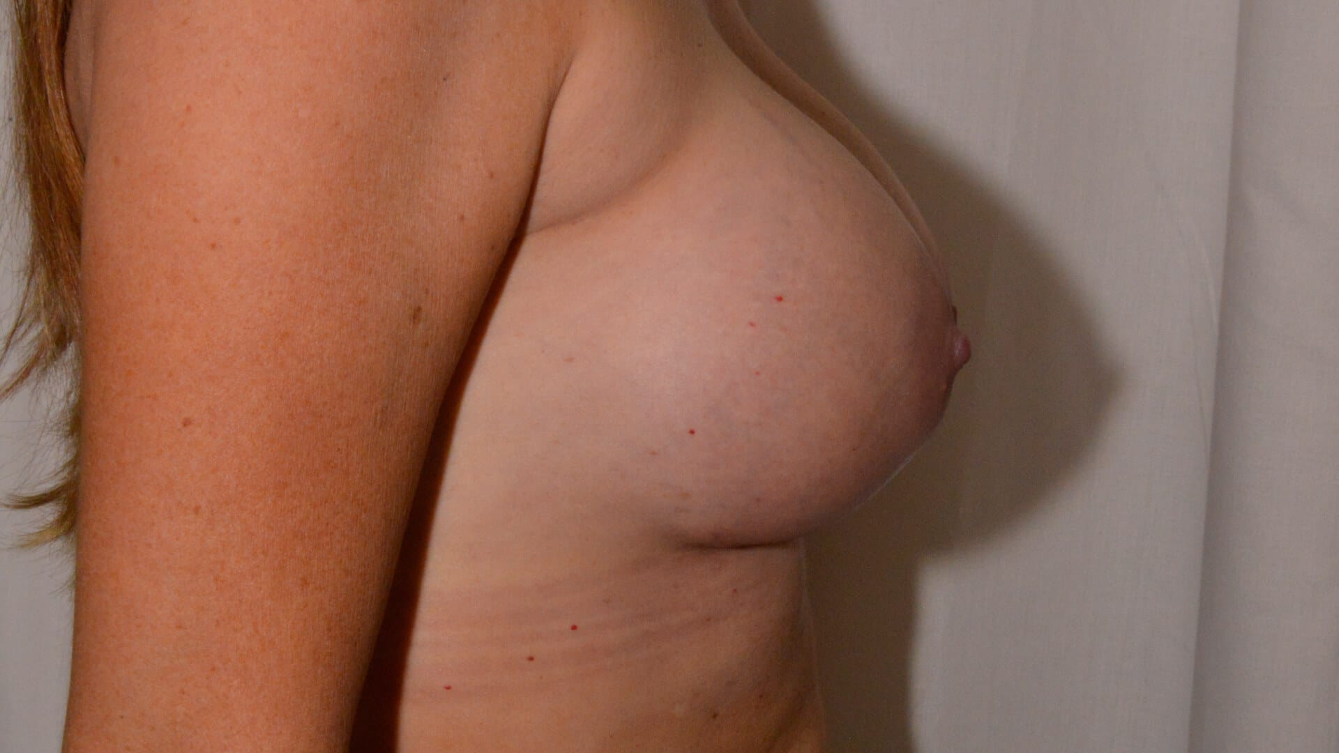 After: BREAST AUGMENTATION – CASE #35658