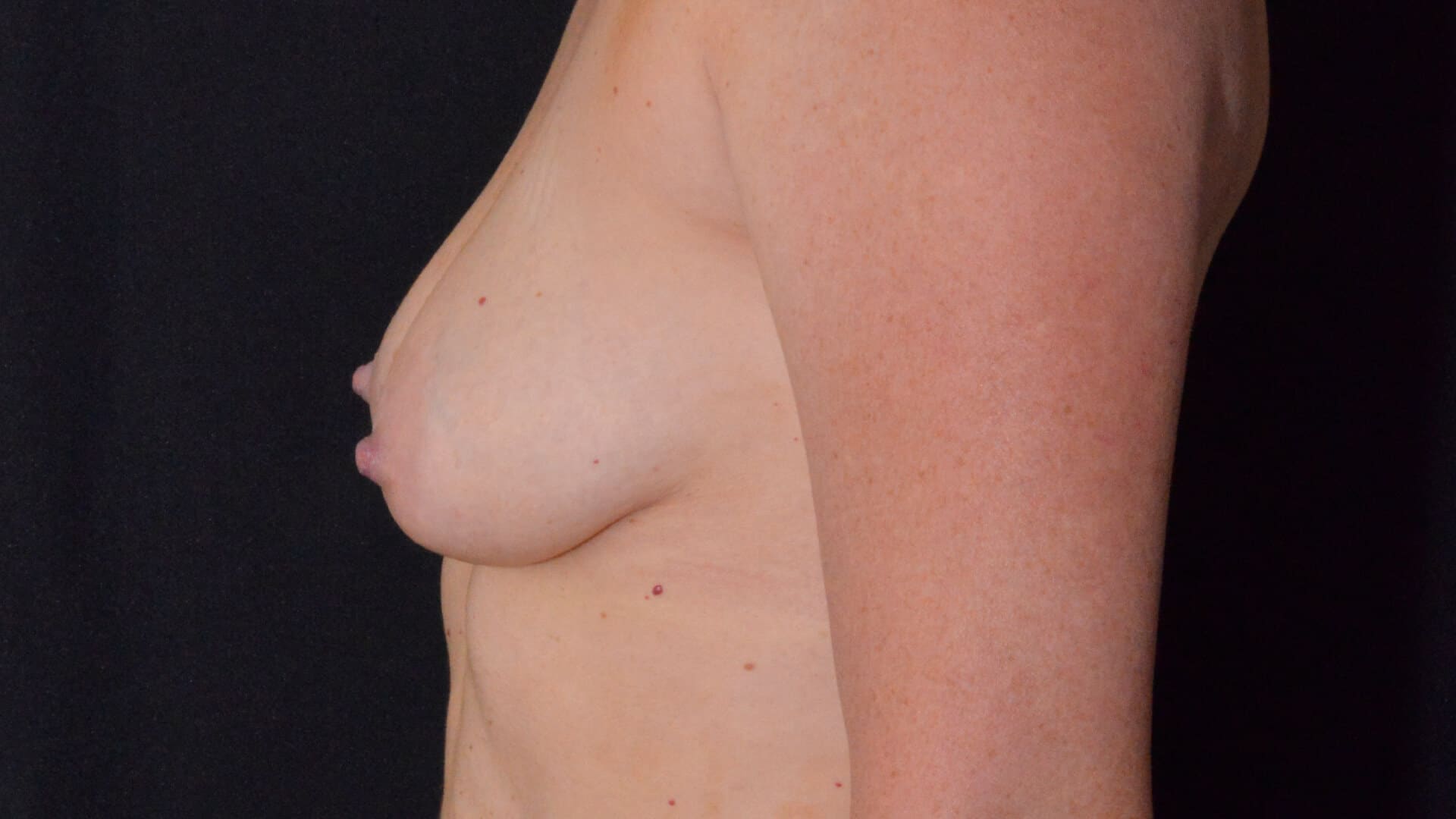 Before: BREAST AUGMENTATION – CASE #35658