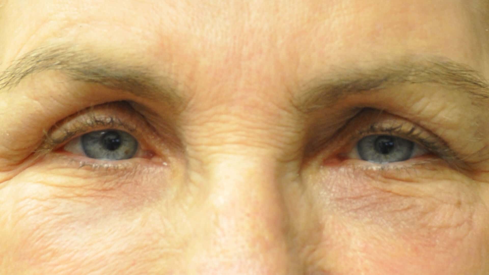 Upper Blepharoplasty Before & After Photos,Upper Eyelid Lift Surgery before & after,Upper Blepharoplasty Before and After Gallery,Upper Eyelid Blepharoplasty Photos,Upper Blepharoplasty before & after, Blepharoplasty (Eyelid Lift) &#8211; Upper