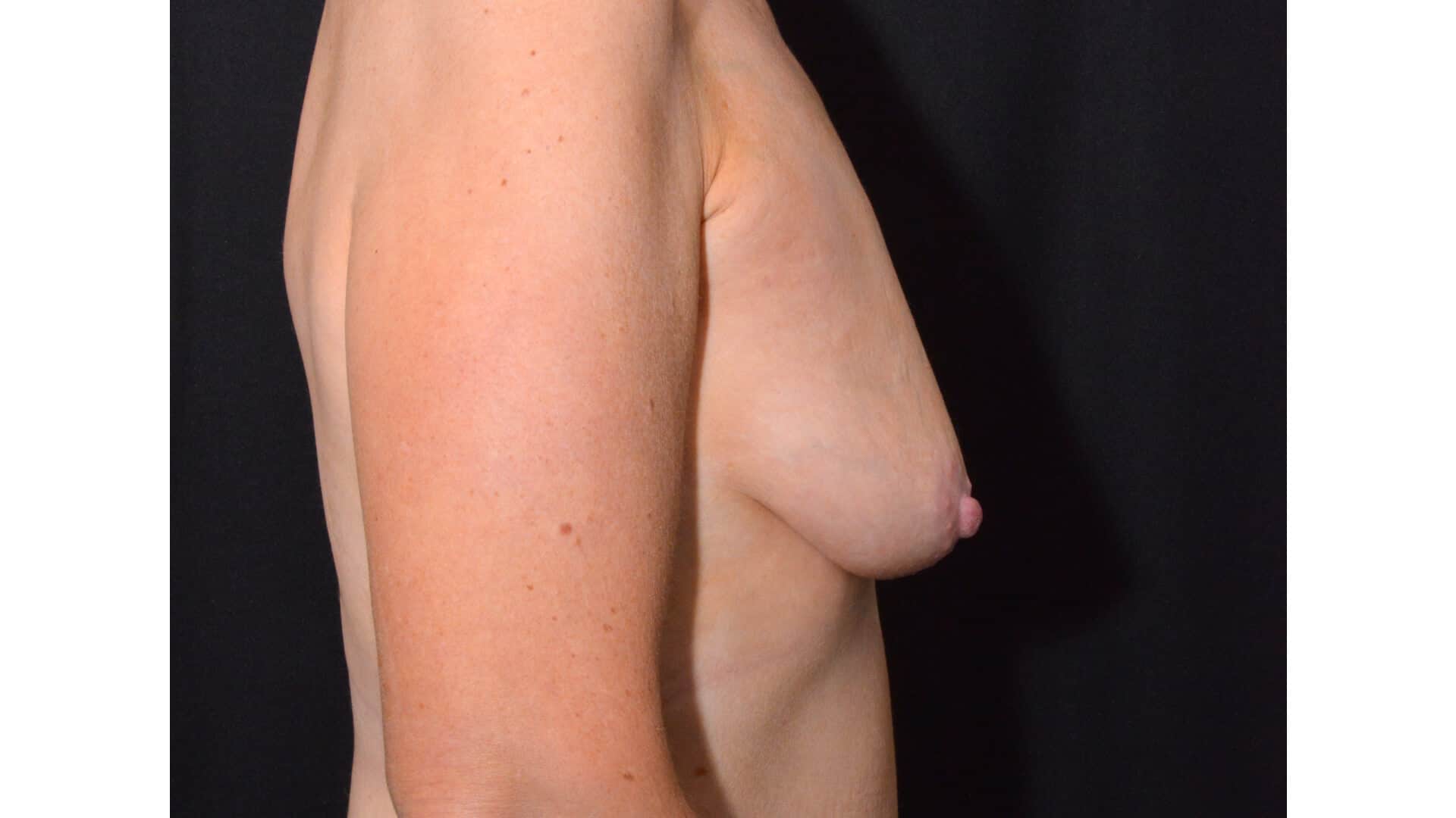 Before: BREAST AUGMENTATION – CASE #35826