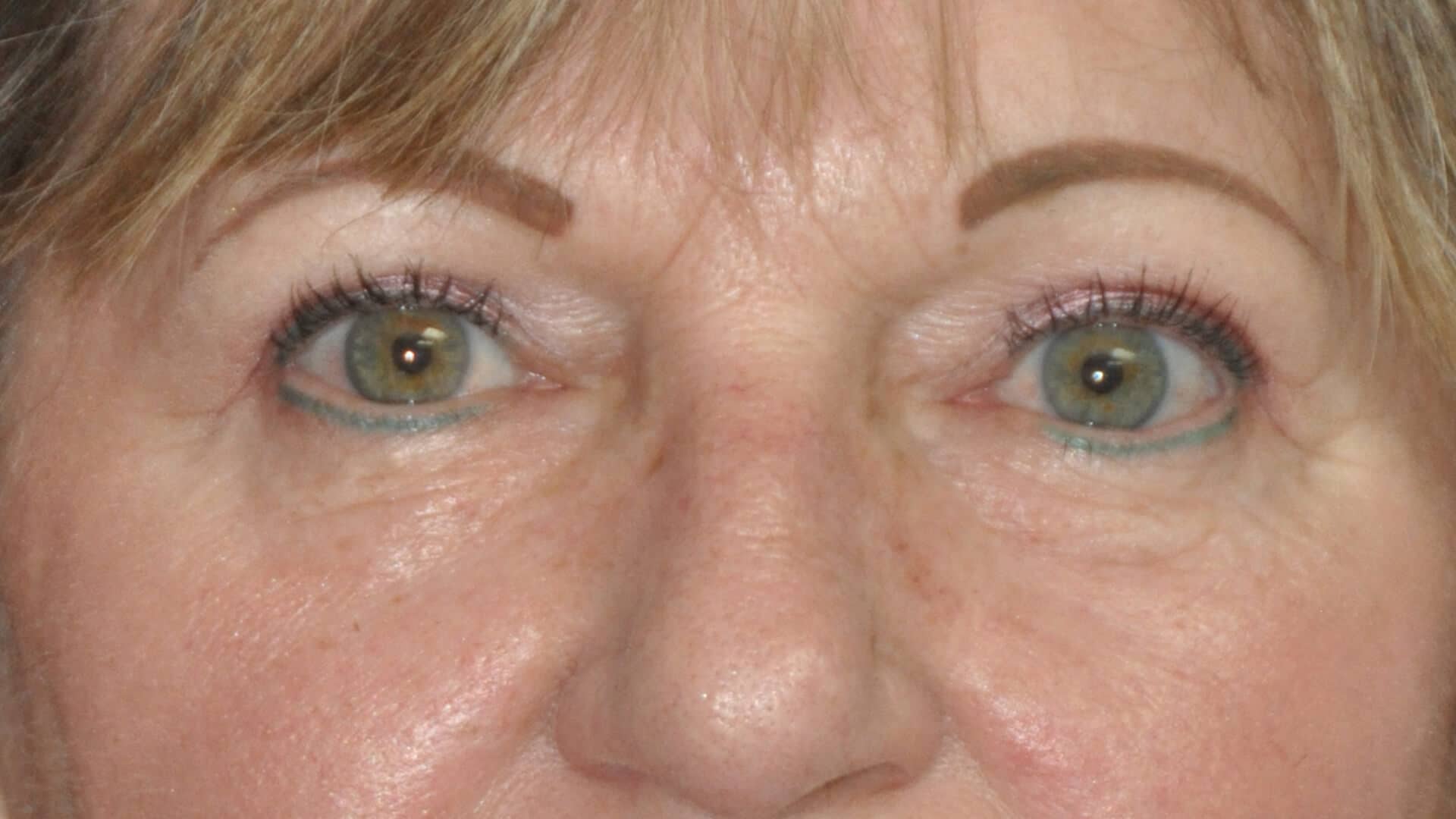 After: Blepharoplasty – CASE #36113