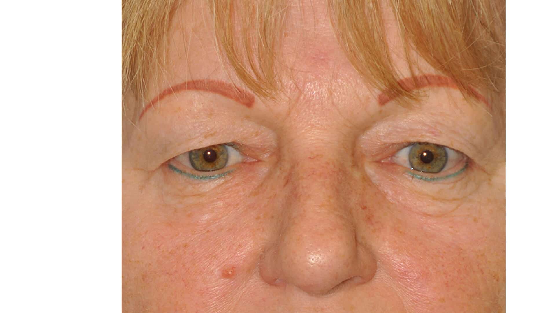 Upper Blepharoplasty Before & After Photos,Upper Eyelid Lift Surgery before & after,Upper Blepharoplasty Before and After Gallery,Upper Eyelid Blepharoplasty Photos,Upper Blepharoplasty before & after, Blepharoplasty (Eyelid Lift) &#8211; Upper