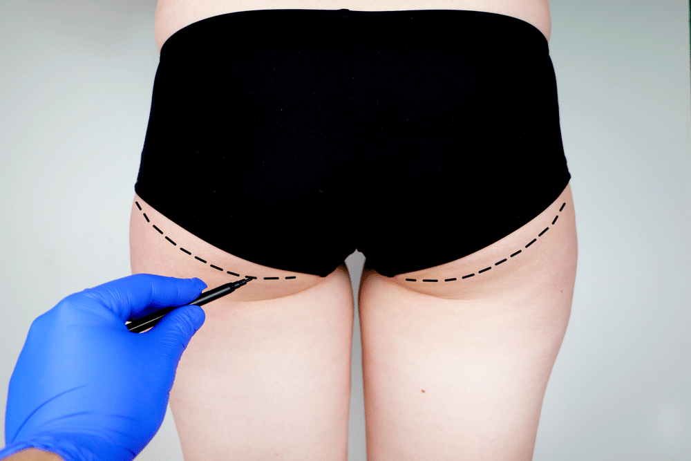 Buttock Lift With Augmentation | Milford MD Cosmetic Dermatology Surgery