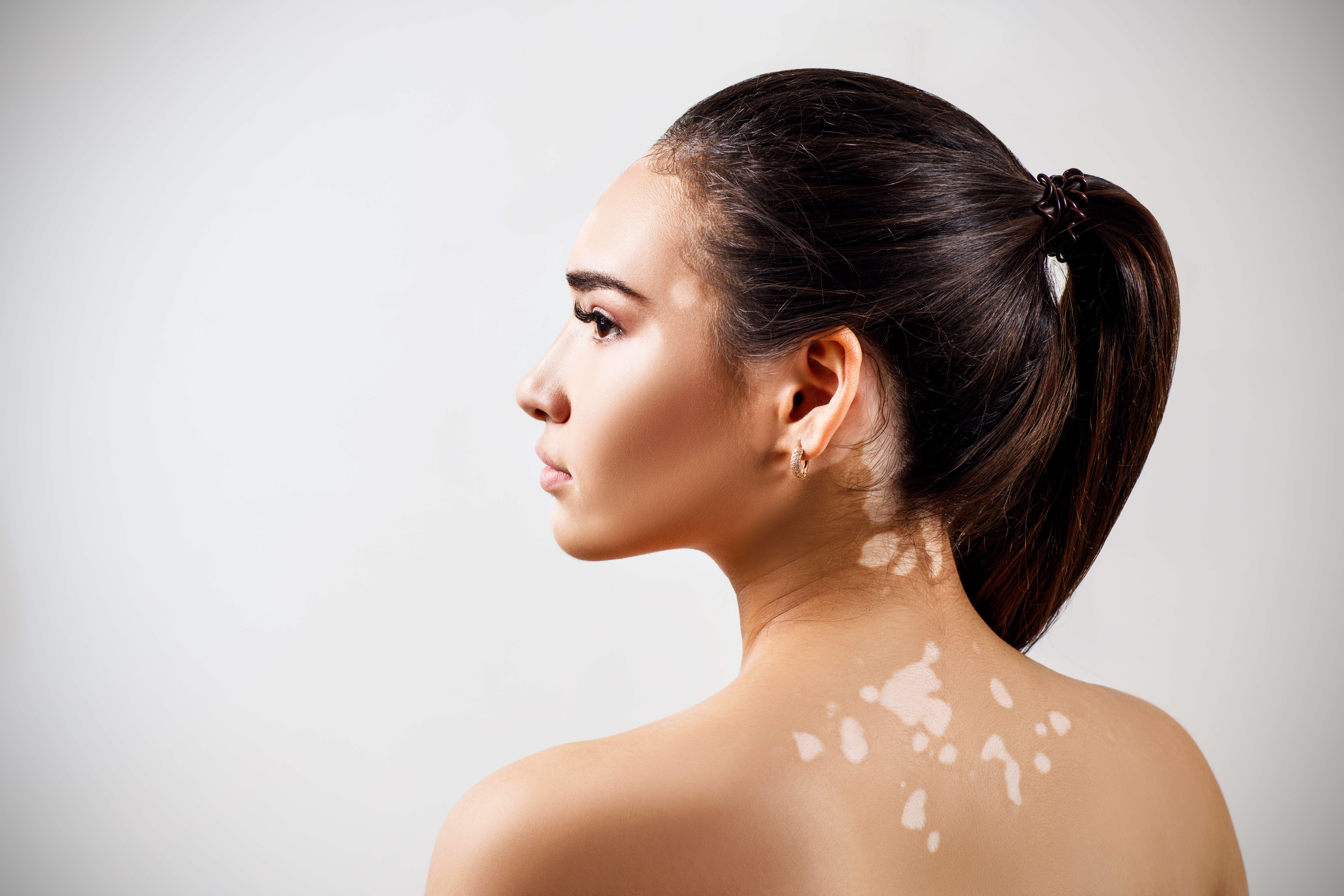 What Is Vitiligo, And How Does It Occur | Milford MD Cosmetic Dermatology