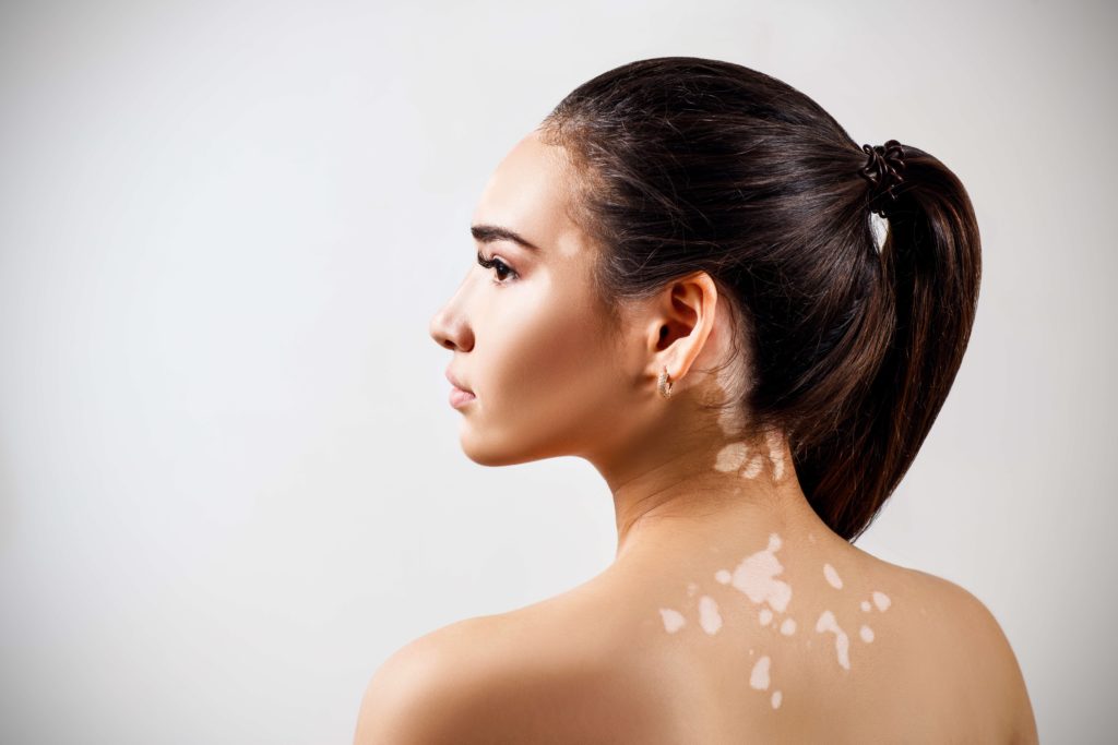 What Is Vitiligo And How Does It Occur by MilfordMD