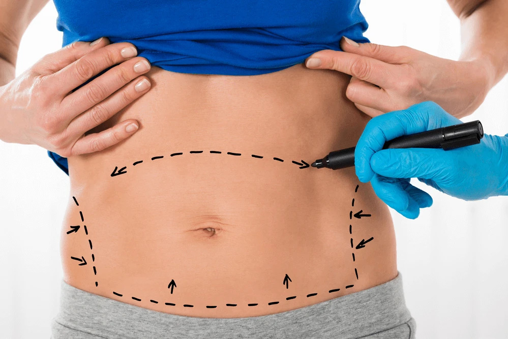 What Happens During a Tummy Tuck by MilfordMD