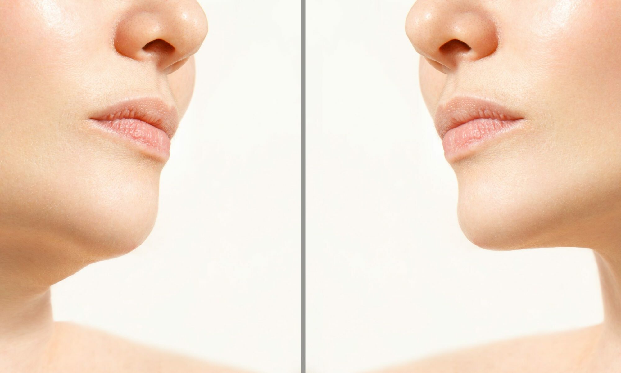 Double Chin Treatment Before & After Image | Milford MD