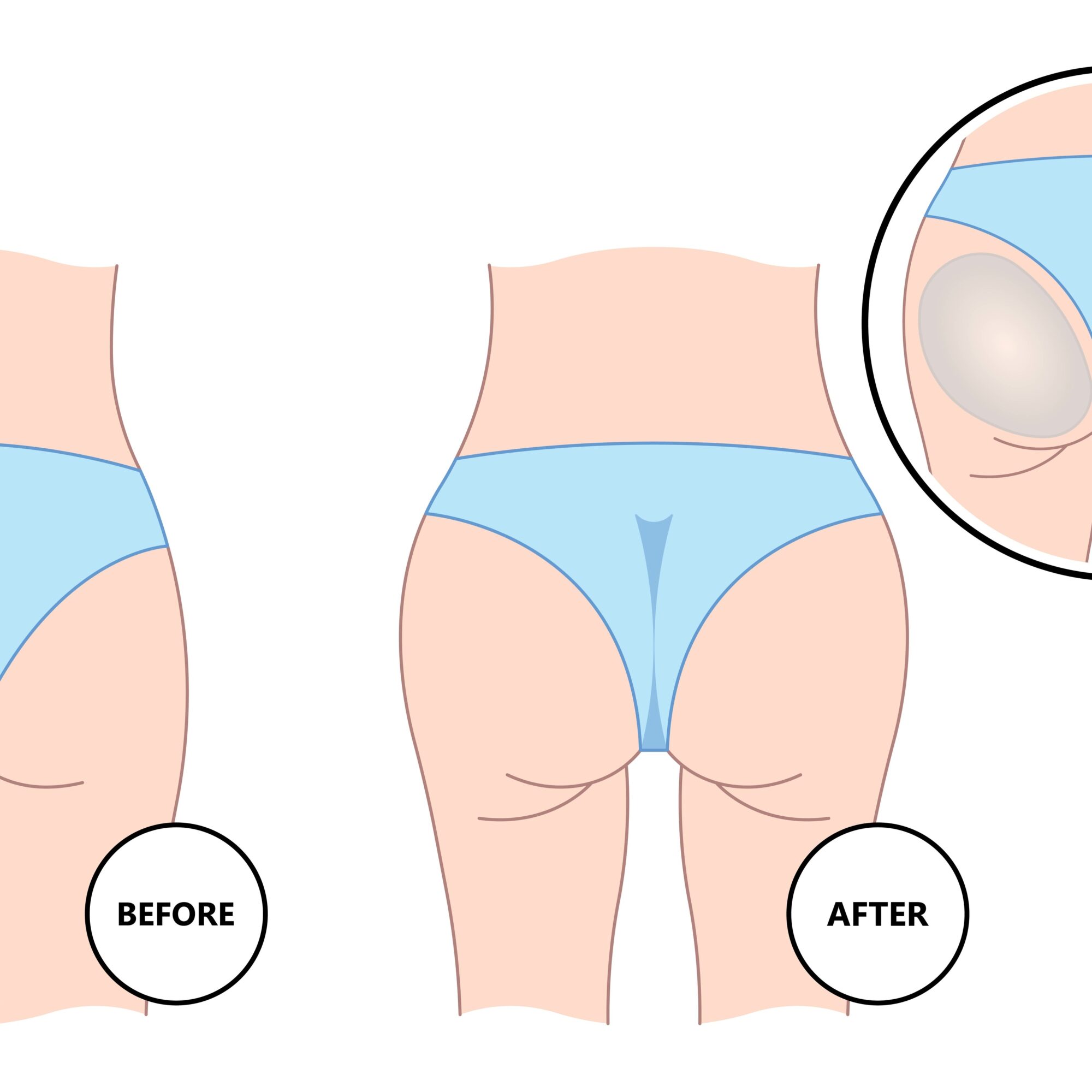 How Long Does It Take To Recover From A Brazilian Butt Lift | Milford MD