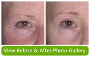 BA Non Surgical Brow Lift at MilfordMD in Milford PA