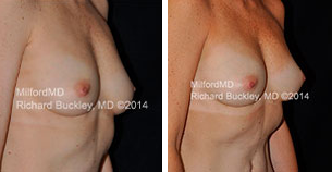 Breast Augmentation fat in Milford PA