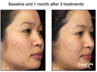 Facial acne sm in Milford PA