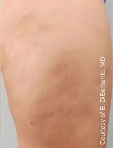 Cellulaze Cellulite Removal Treatment by MilfordMD in Richard Buckley, MD