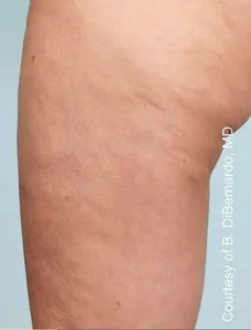 Cellulaze Cellulite Removal Treatment by MilfordMD in Richard Buckley, MD