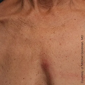 after-treatment-img