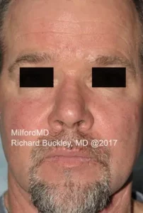 VBeam Rosacea 1972 Front After in Milford, PA