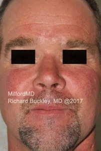 VBeam Rosacea 1972 Front Before in Milford, PA