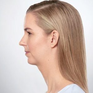 Kybella Treatment by MilfordMD in Richard Buckley, MD