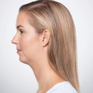 Kybella Treatment by MilfordMD in Richard Buckley, MD