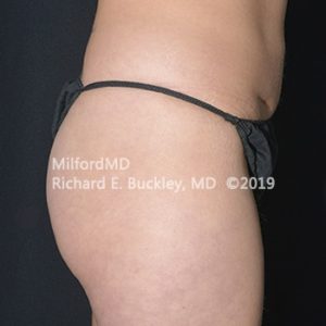 Sculptra Butt Lift Treatment by MilfordMD in Richard Buckley, MD