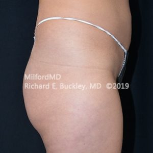 Sculptra Butt Lift Treatment by MilfordMD in Richard Buckley, MD