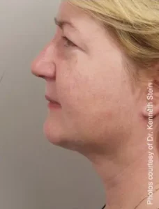 Smartlipo Triplex Laser Neck Lift Treatment by MilfordMD in Richard Buckley, MD