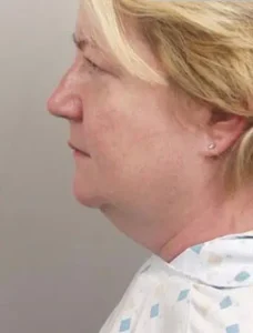 Smartlipo Triplex Laser Neck Lift Treatment by MilfordMD in Richard Buckley, MD