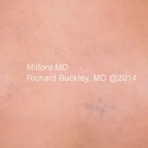 Laser tattoo fading treatment at Milford PA