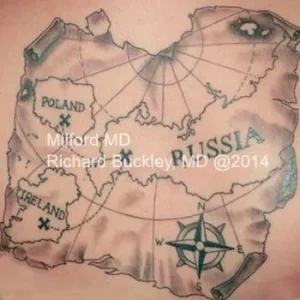 Laser tattoo fading procedure in Milford PA