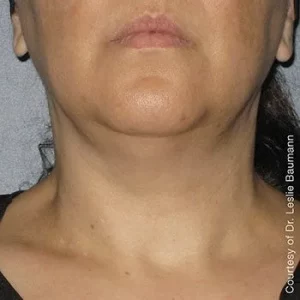 Neck Lift Non Surgical Treatment by MilfordMD in Richard Buckley, MD