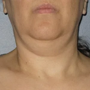 Neck Lift Non Surgical Treatment by MilfordMD in Richard Buckley, MD