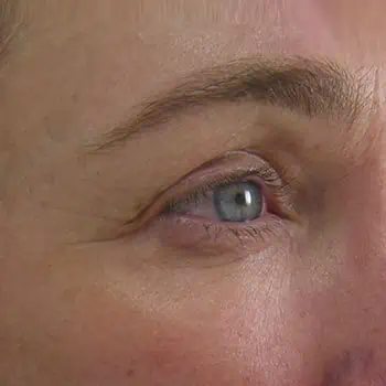 after-treatment-img