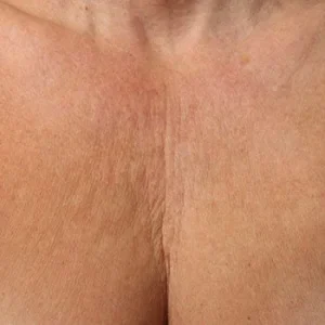 Decolletage Rejuvenation surgery in Milford PA