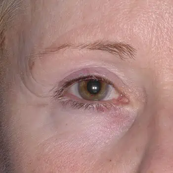 after-treatment-img