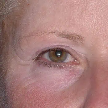 before-treatment-img